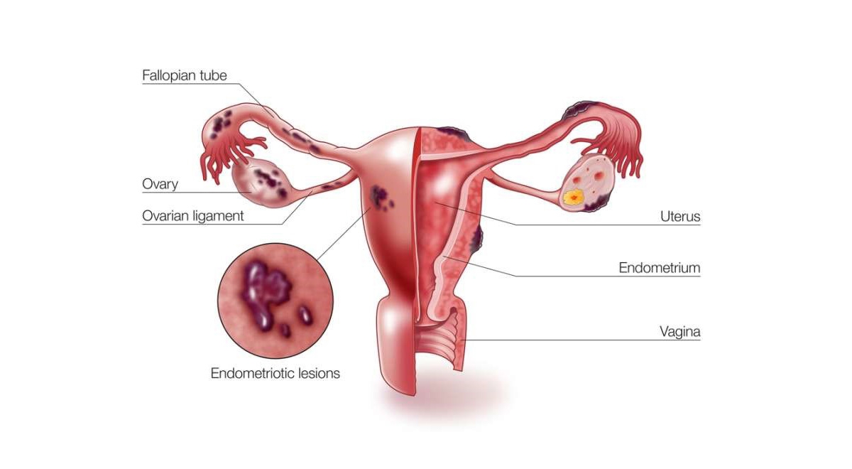 endometriosis/اندومتریوز
