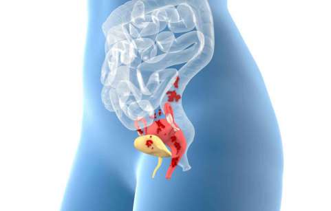 endometriosis/اندومتریوز