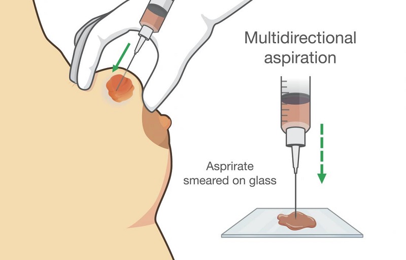 m/بیوپسی از پستان