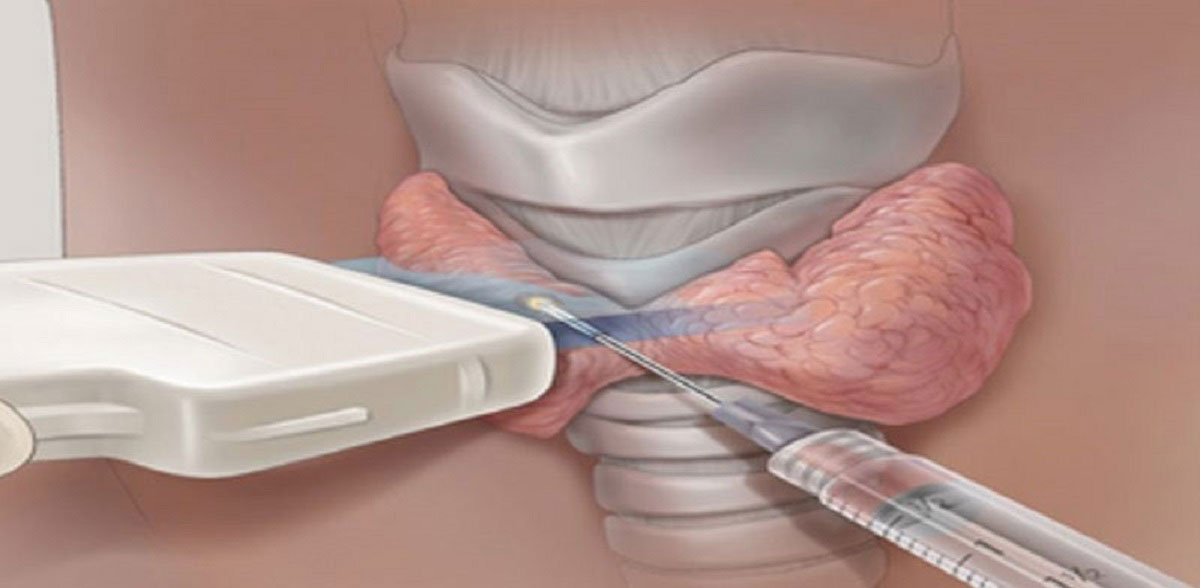 d/آمادگی سونو گرافی FNA تیروئید