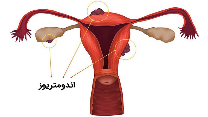 d/تصویر اندومتریوز