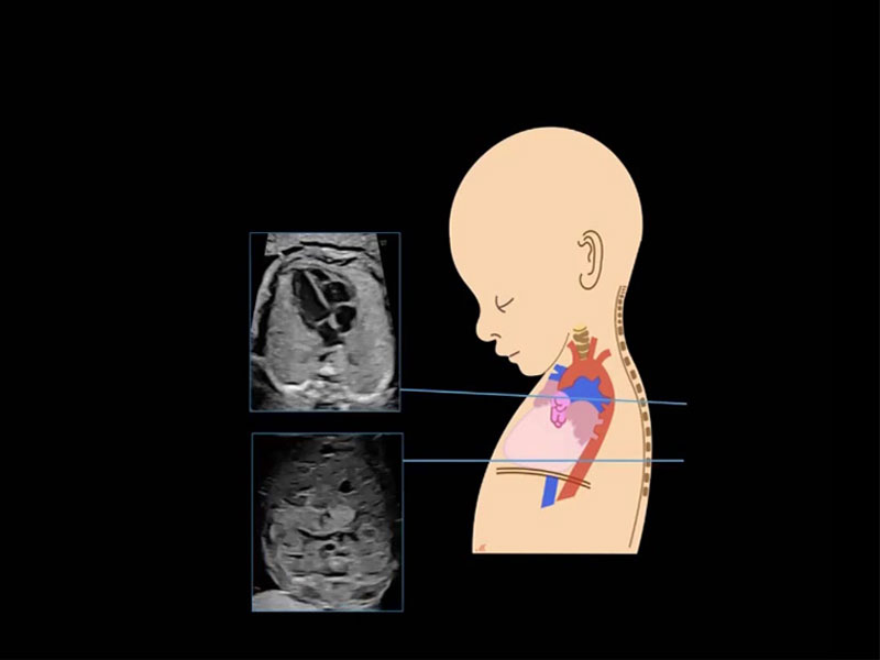 g/اکوکاردیوگرافی جنین ( اکوی قلب جنین )