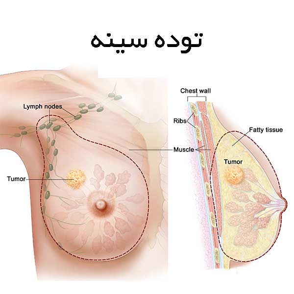 t/فیبروآدنوم چیست؟