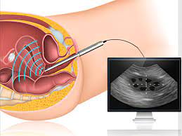 r/سونوگرافی واژینال در تهران