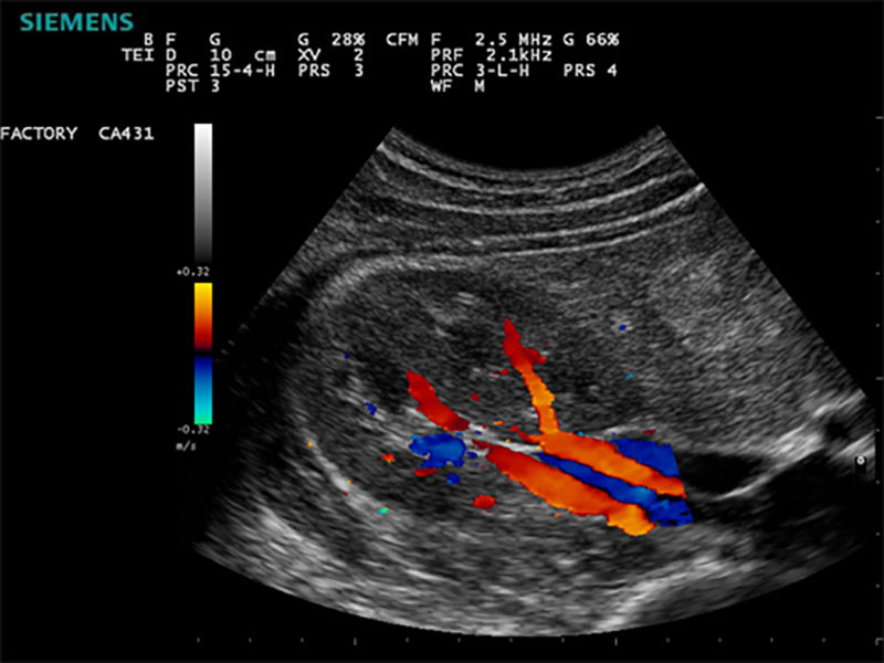f/سونوگرافی داپلر در بارداری چیست؟