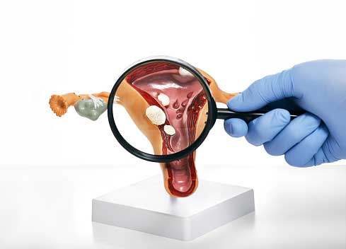 What is a color photo of the uterus?/عکس رنگی رحم چیست؟