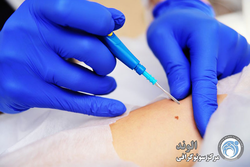 d/بیوپسی از کلیه نقاط بدن