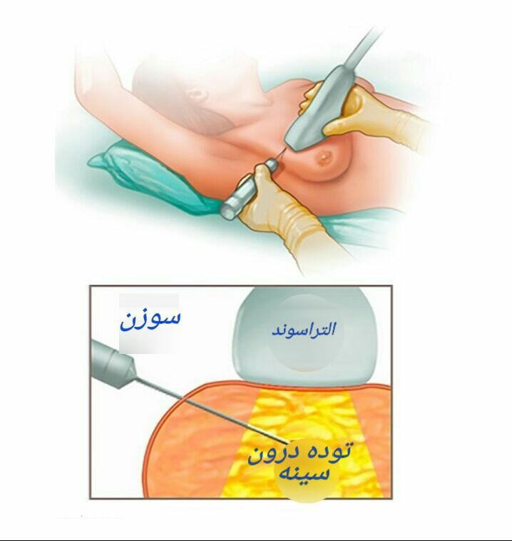 f/بیوپسی سینه