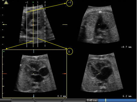 Echocardiography/اکوی قلب جنین در دوران بارداری