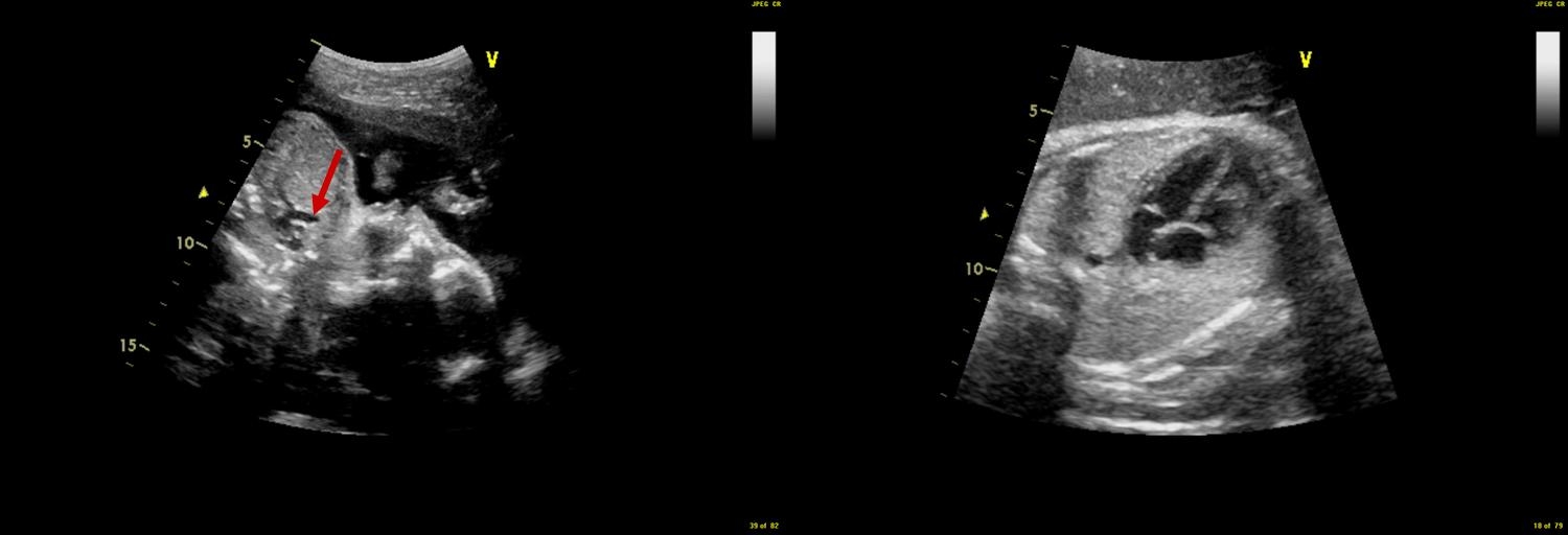 ecocardiography/اکوی قلب جنین چیست و چرا انجام می شود؟