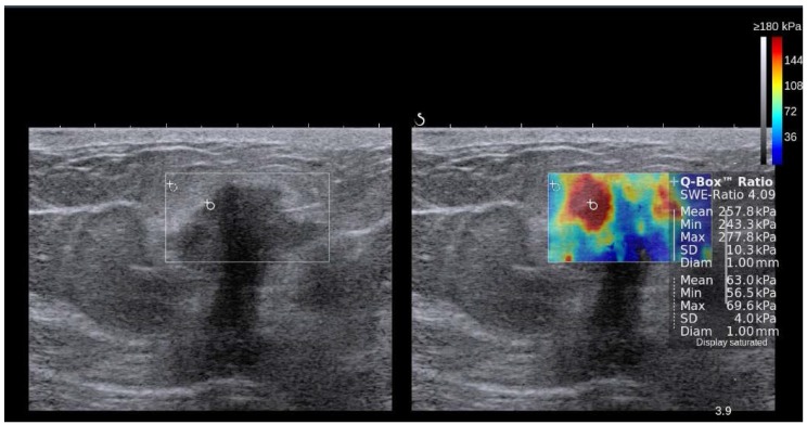 elastography/الاستوگرافی