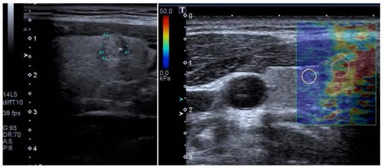 elastography/الاستوگرافی