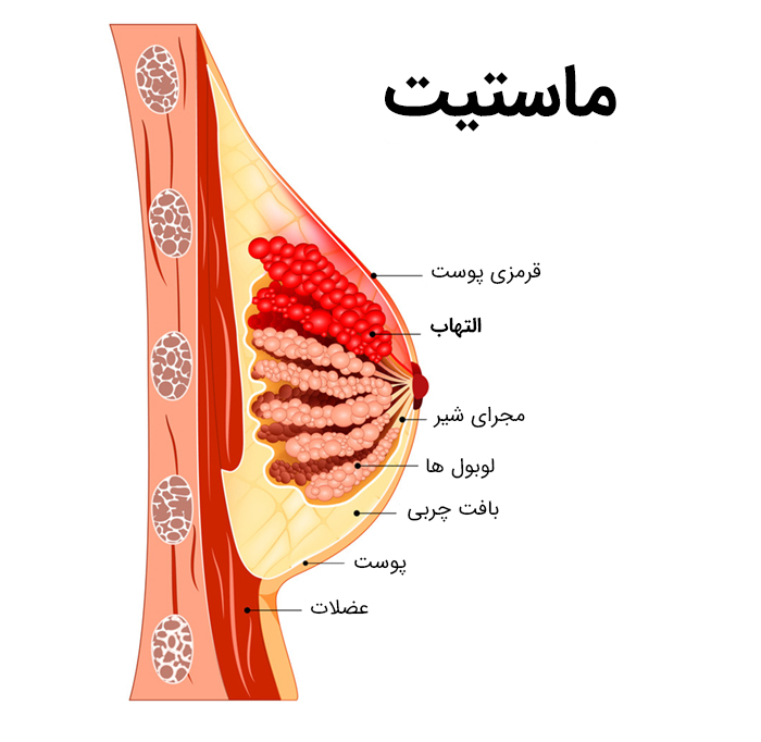 d/عفونت پستان یا ماستیت چیست؟