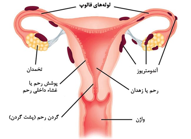 J/مرکز سونوگرافی آندومتریوز