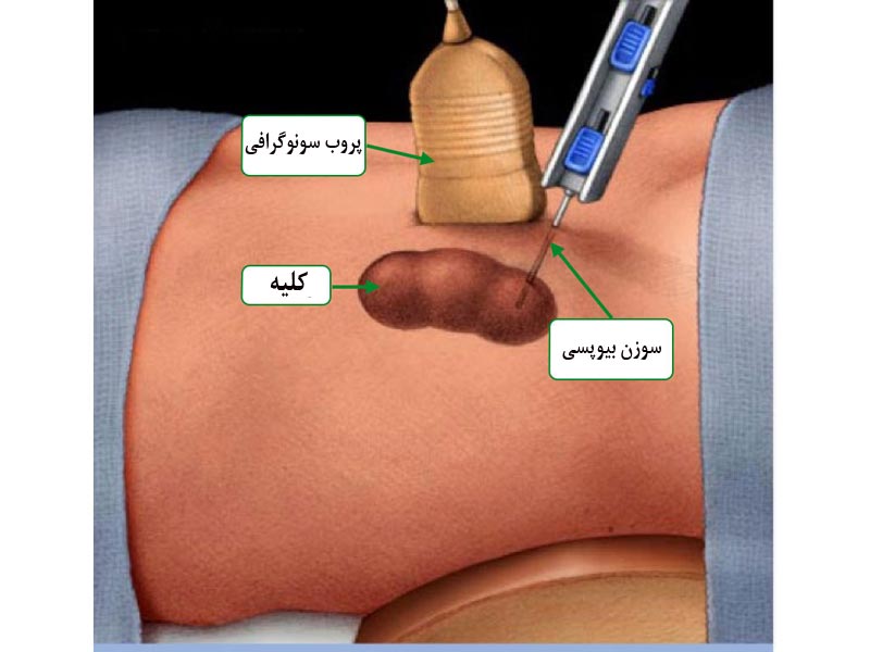 y'بیوپسی کلیه و تشخیص بیماری های کلیوی