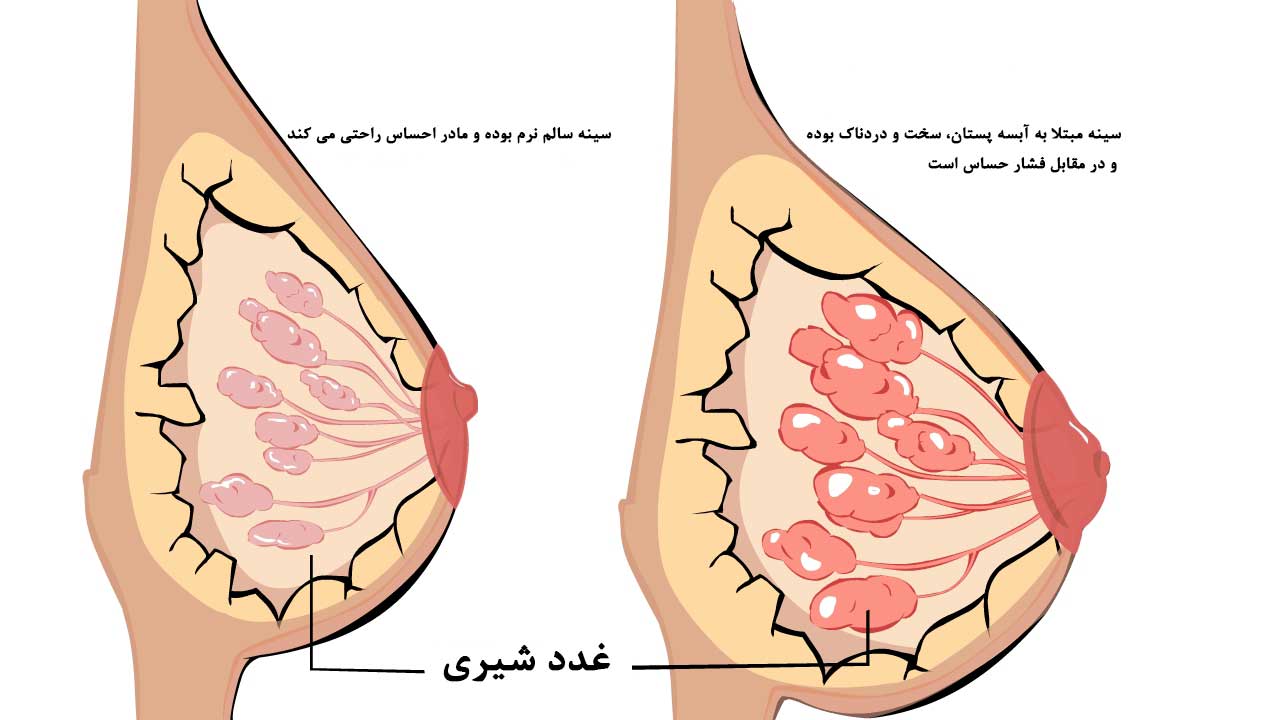 r/عفونت پستان