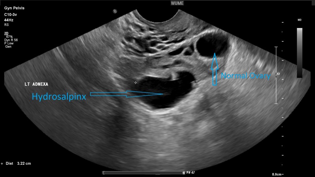 The best time for a vaginal ultrasound/بهترین زمان برای سونوگرافی واژینال