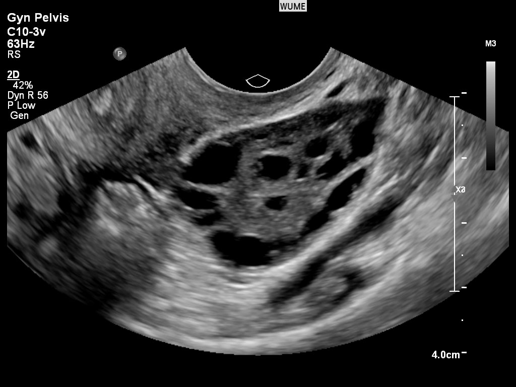 The best time for a vaginal ultrasound/بهترین زمان برای سونوگرافی واژینال