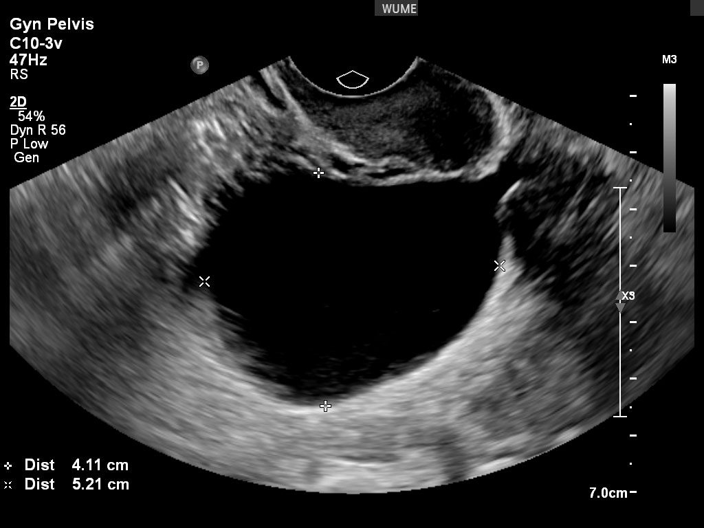 The best time for a vaginal ultrasound/بهترین زمان برای سونوگرافی واژینال