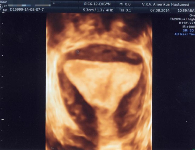 ultrasound of the uterus/سونوگرافی سه بعدی رحم