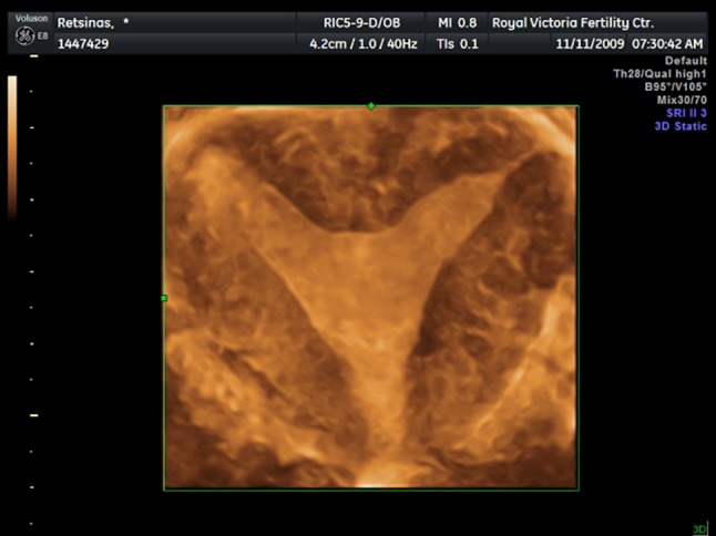 Three-dimensional ultrasound of the uterus/سونوگرافی سه بعدی رحم