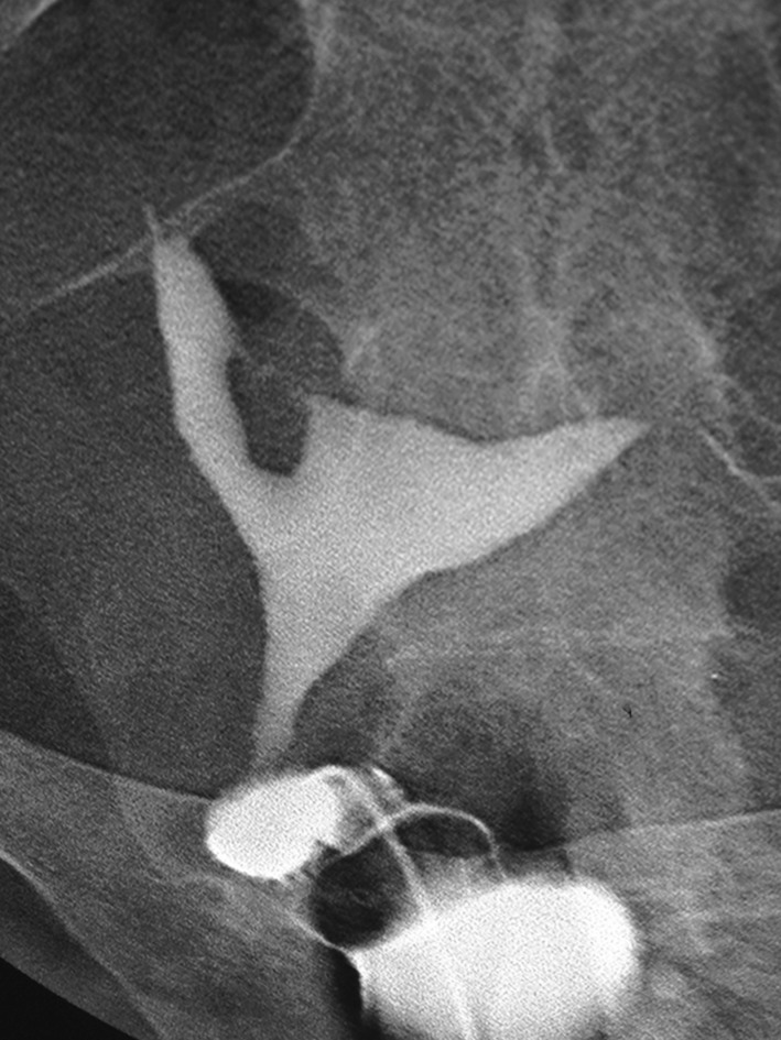 Three-dimensional ultrasound of the uterus/سونوگرافی سه بعدی رحم